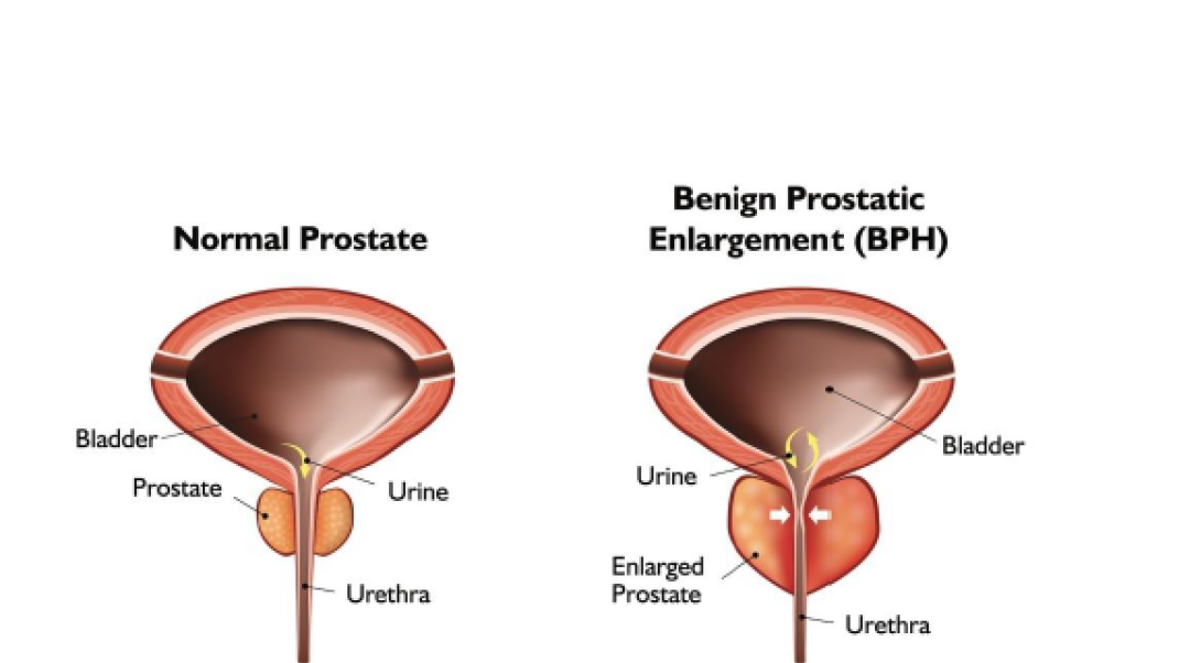 Normal vs Benign Prostatic Enlargement