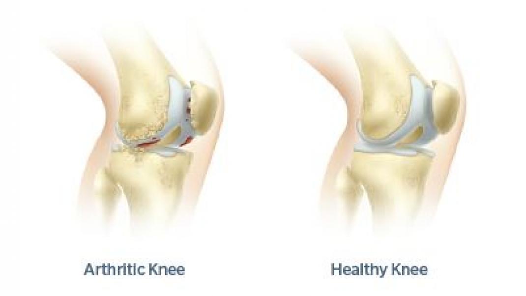 Arthritic Knee